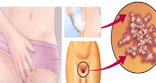 Tube luttons contre les infections vaginal et urinaire( homme comme femme)